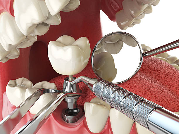 Best Emergency Root Canal Treatment in Gra Forks, ND